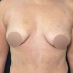 Breast Lift Before & After Patient #733