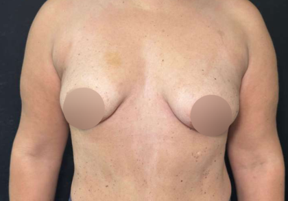 Breast Lift Before & After Patient #733