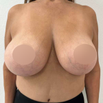 Breast Lift Before & After Patient #742