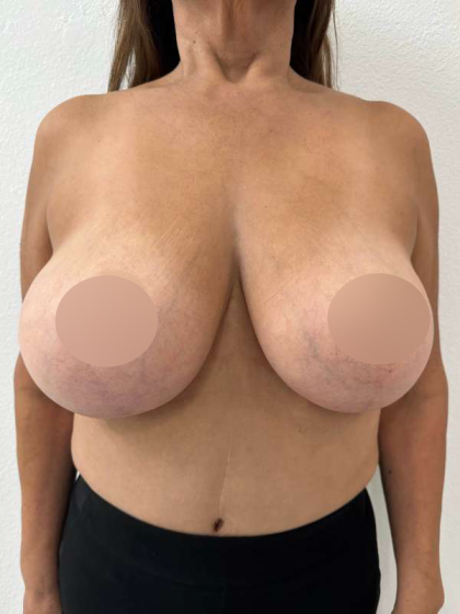 Breast Lift Before & After Patient #742