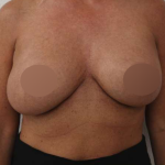 Breast Lift Before & After Patient #730