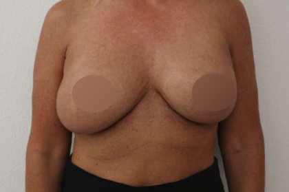 Breast Lift Before & After Patient #730