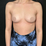 Breast Augmentation Before & After Patient #656