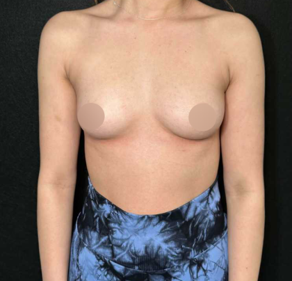 Breast Augmentation Before & After Patient #656