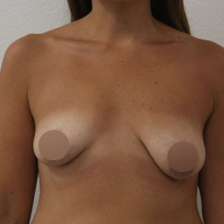 Breast Lift Before & After Patient #745