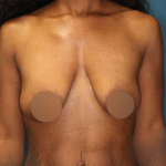 Breast Lift Before & After Patient #752