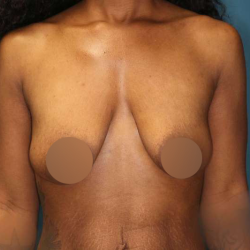 Breast Lift Before & After Patient #752