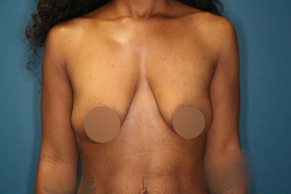 Breast Lift Before & After Patient #752