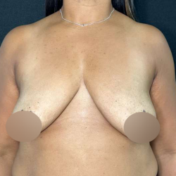 Breast Lift Before & After Patient #718