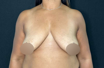 Breast Lift Before & After Patient #718