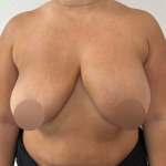 Breast Lift Before & After Patient #724
