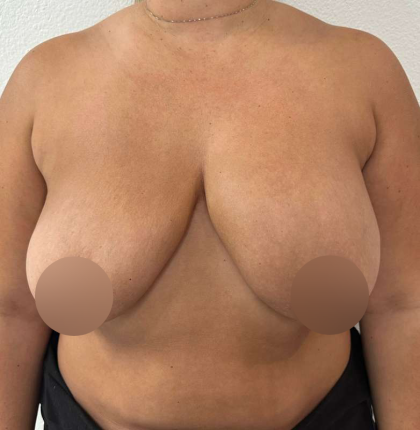 Breast Lift Before & After Patient #724