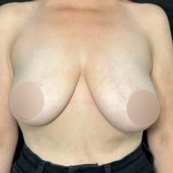 Breast Lift Before & After Patient #727