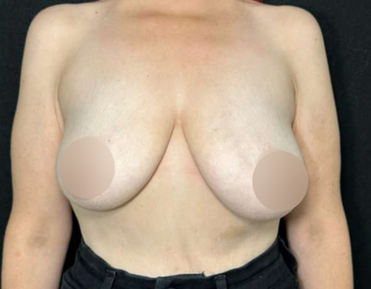 Breast Lift Before & After Patient #727