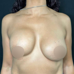 Breast Lift Before & After Patient #566
