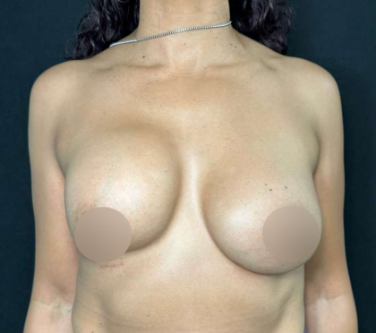 Breast Lift Before & After Patient #566