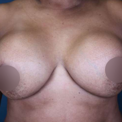 Breast Lift Before & After Patient #578