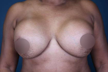 Breast Lift Before & After Patient #578