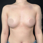 Breast Augmentation Before & After Patient #644