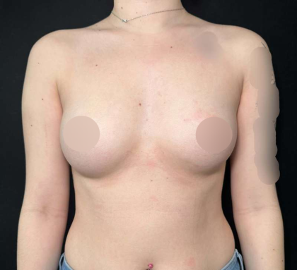 Breast Augmentation Before & After Patient #644
