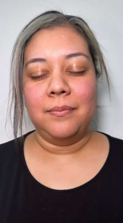 Chin Lipo Before & After Patient #779