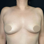 Breast Augmentation Before & After Patient #641