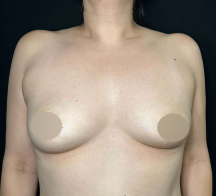 Breast Augmentation Before & After Patient #641