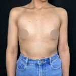 Breast Augmentation Before & After Patient #647
