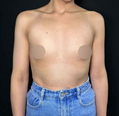 Breast Augmentation Before & After Patient #647