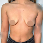 Breast Augmentation Before & After Patient #662
