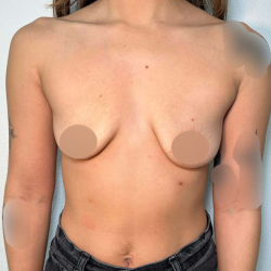 Breast Augmentation Before & After Patient #662