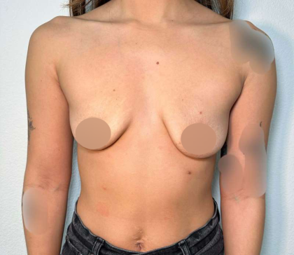 Breast Augmentation Before & After Patient #662