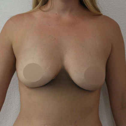 Breast Augmentation Before & After Patient #665