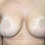 Breast Lift Before & After Patient #739