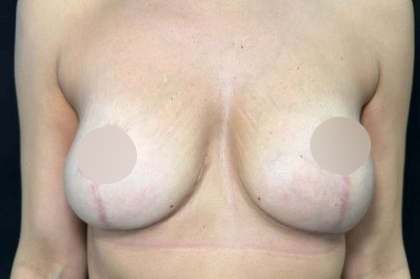 Breast Lift Before & After Patient #739