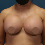 Breast Augmentation Before & After Patient #693