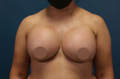 Breast Augmentation Before & After Patient #693