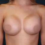 Breast Augmentation Before & After Patient #700