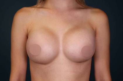 Breast Augmentation Before & After Patient #700