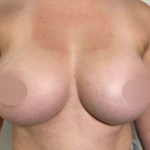 Breast Augmentation Before & After Patient #706