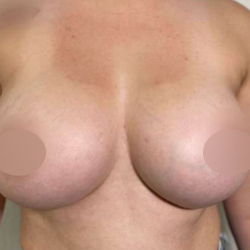 Breast Augmentation Before & After Patient #706