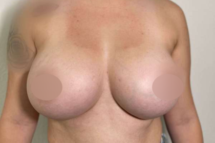 Breast Augmentation Before & After Patient #706