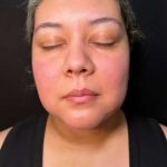 Chin Lipo Before & After Patient #779