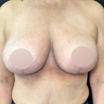 Breast Lift Before & After Patient #742