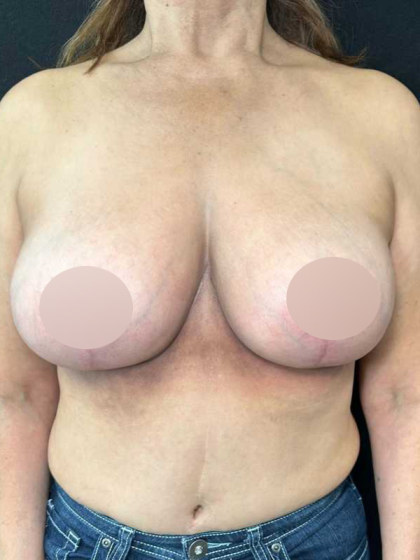 Breast Lift Before & After Patient #742