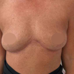 Breast Lift Before & After Patient #730