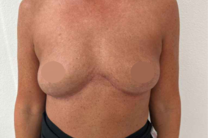Breast Lift Before & After Patient #730