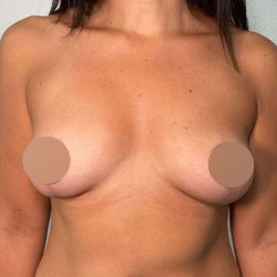 Breast Lift Before & After Patient #745