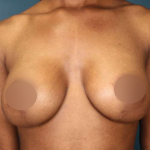 Breast Lift Before & After Patient #752