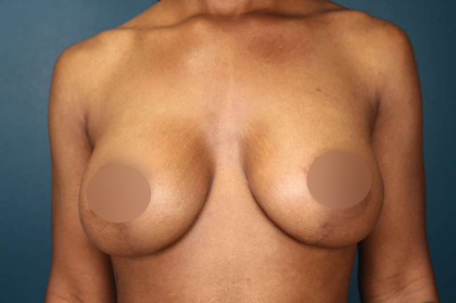 Breast Lift Before & After Patient #752